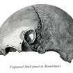 Drawing of the trepanned skull (Hewison 1893, 71).