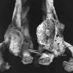Post ex photograph : arthritis in bone from skeleton from grave III.